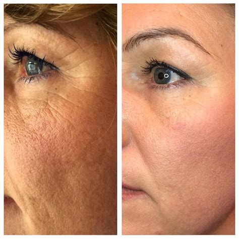 Mezotix - Kosmetik Hofmann | Medical Beauty
