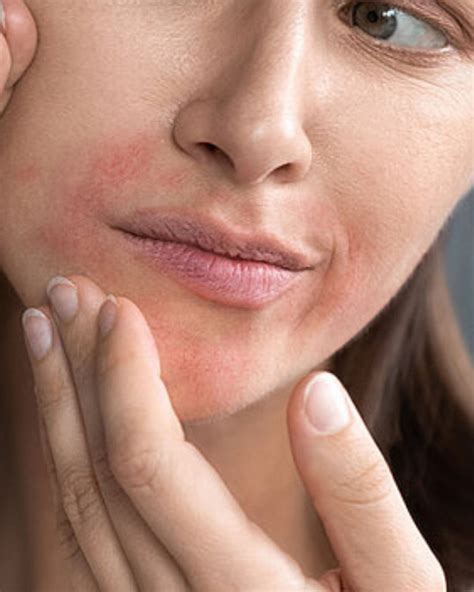 Periorale Dermatitis – bedrop.de