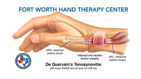 De Quervain's Disease - De Quervain’s Tenosynovitis