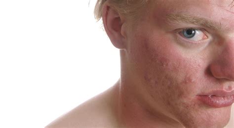 Celiac Disease Rash: Overview, Symptoms and Treatment - HealthPulls