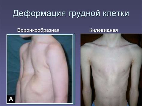 Рахит (от греч.rhahis — спинной хребет) - презентация онлайн