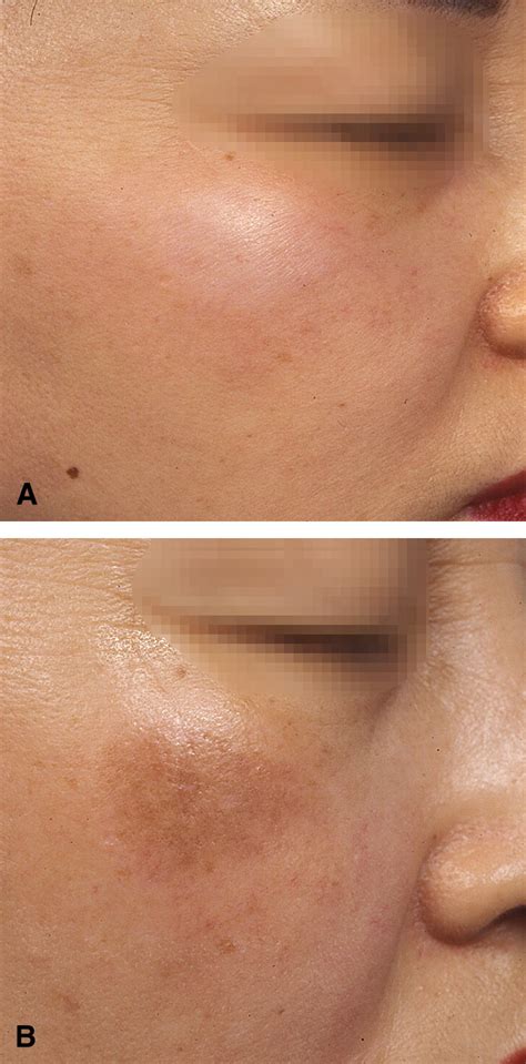 pigmentation   topical tacrolimus  treat lichen sclerosus