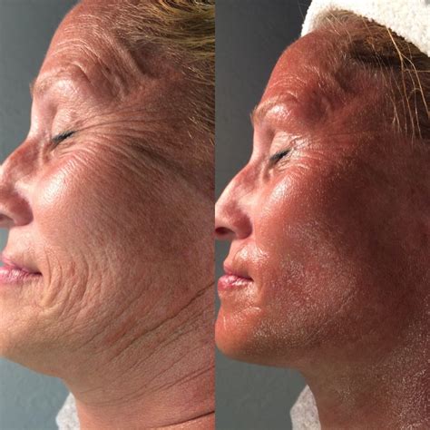 Cryoskin Facial: How It Works What Are Its Benefits, 45% OFF