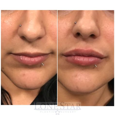 lip line botox 6