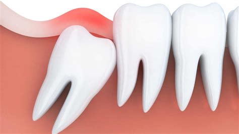 Do Dentists Break Your Jaw To Remove Wisdom Teeth?
