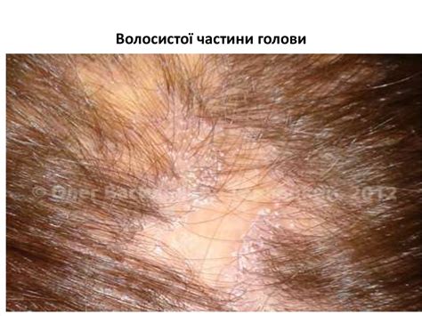 Папулосквамозні дерматози - презентация онлайн