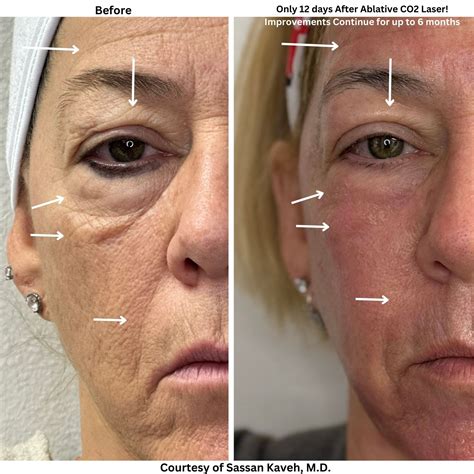 ablative laser resurfacing  ultrapulse alpha  alpha medical