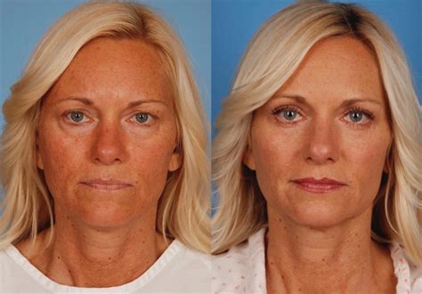 upper blepharoplasty