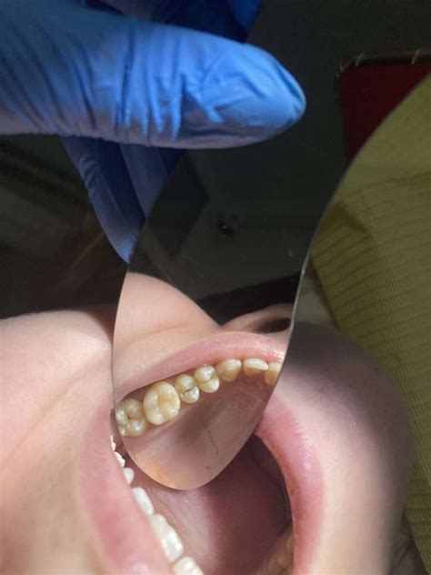 Реставрація Зубів | Стоматологія • Dental Guru • Київ