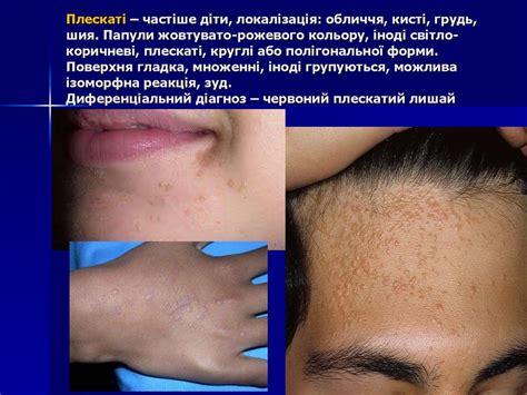 Пухирні дерматози - презентация онлайн