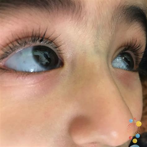 blue sclerae skin deep