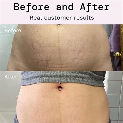 Best Stretch Mark Prevention & Removal Cream for Pregnancy | Tummy Butter & Shea Butter Lotion
