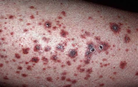 polyarteritis nodosa  symptoms diagnosis treatment survival