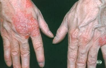 Nummular Dermatitis: Foothill Dermatology Medical Center: Dermatology