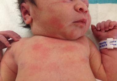Erythema Toxicum Neonatorum Clinical Presentation: History, Physical ...