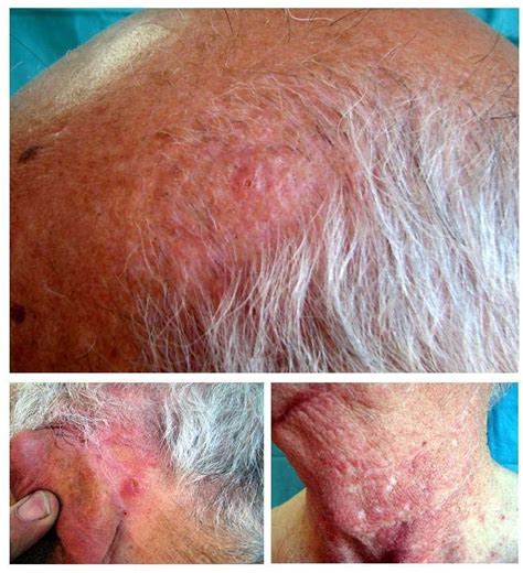 Figure 1 from Scalp folliculitis with Demodex: innocent observer or ...