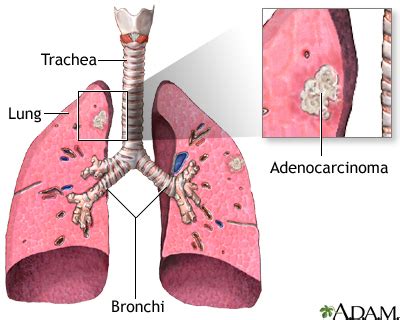 Adenocarcinoma: MedlinePlus Medical Encyclopedia Image