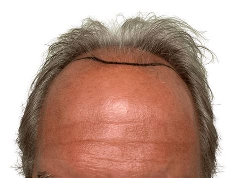 hair transplant hair restoration clinic  boca raton fl