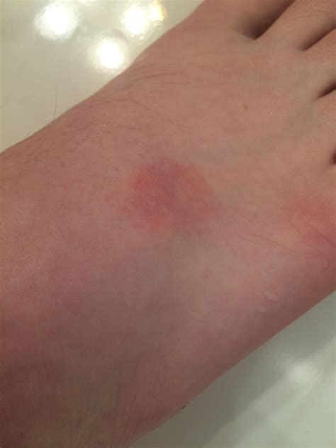 Red spot on foot. No itch, no pain, 2 weeks so far : medical