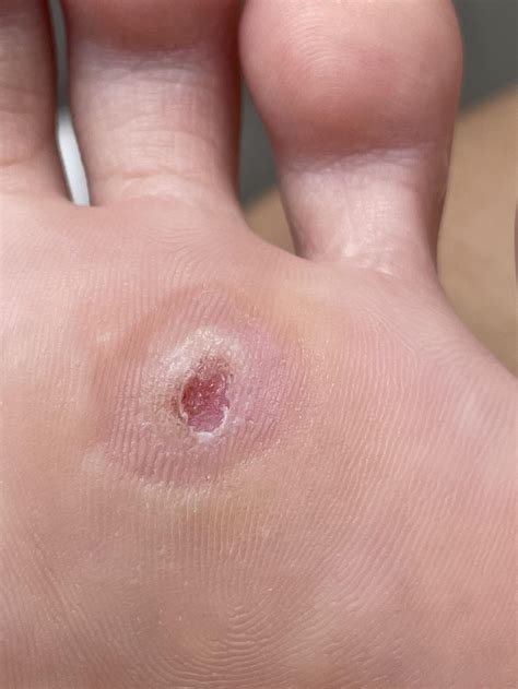 Post one freezing session and the doc says it’s mostly gone - but any