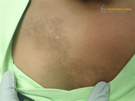 Brown patch with follicular sparing on the chest. (click images for