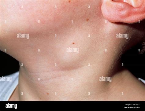 swollen glands close    swollen lymph node gland   neck