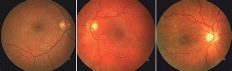 Дистрофии сетчатки глаза - Retina