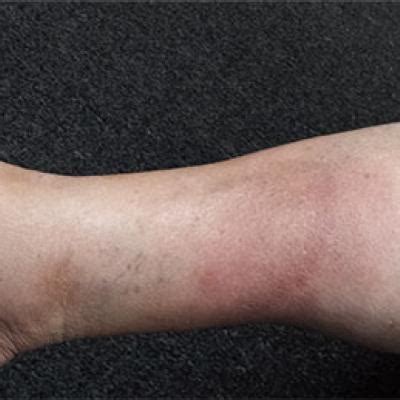 Painful Lesion Hasn’t Responded to Antibiotics | Clinician Reviews