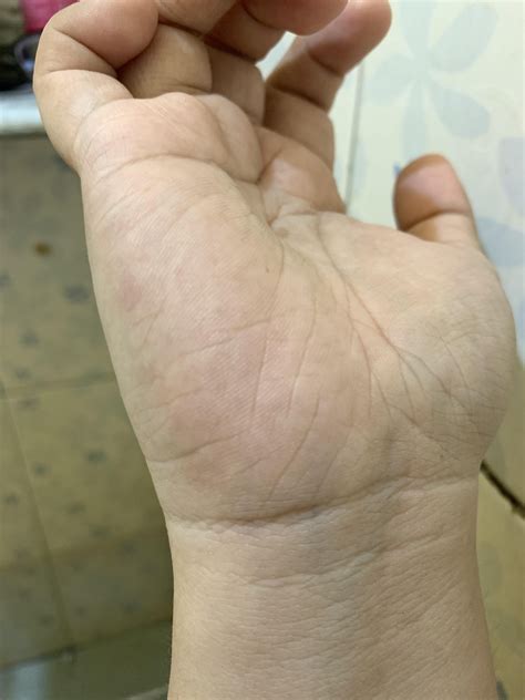 palmar erythema? : r/LiverDisease