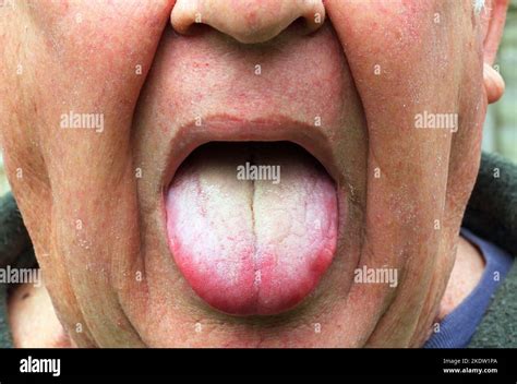 Lengua blanca recubierta. Posiblemente debido a la candidiasis o ...