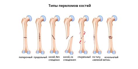 Переломы костей