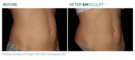 Emsculpt Before and After | Real Patient Results Yonkers, NY