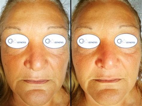 Bio Re Peel - Real You Clinic – Twickenham & Richmond