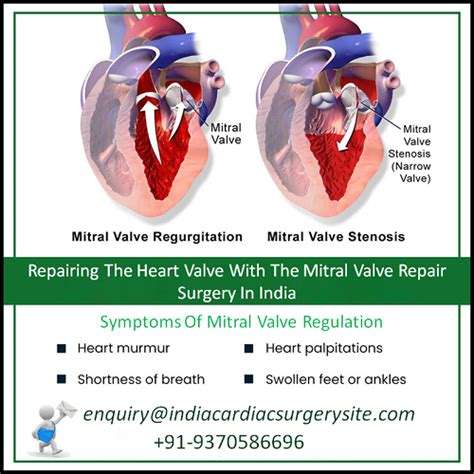 Repairing The Heart Valve With The Mitral Valve Repair Surgery In India - India Cardiac Surgery ...