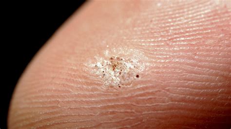 seed warts  prevention  treatment