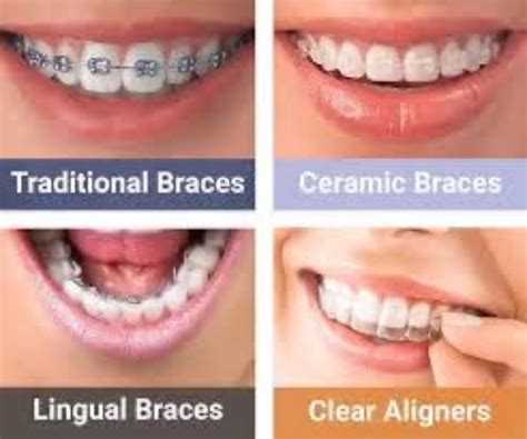 adult braces frazer dental