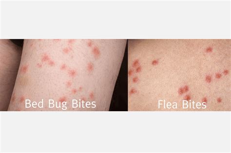 51+ Bed Bug Pictures | Real Photos of Bed Bug Bites