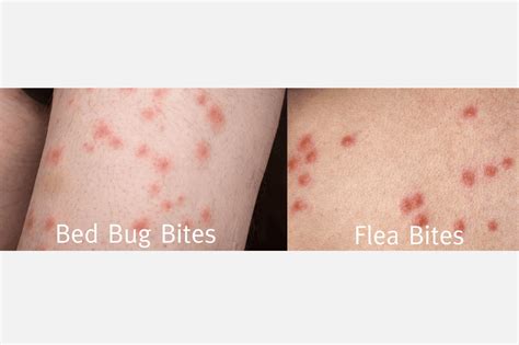 What Is A Bed Bug Rash at Richard Hayes blog