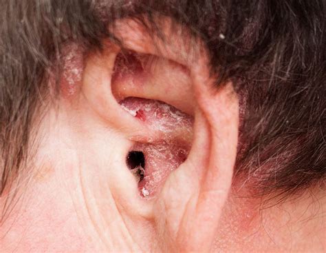 Thuốc Nhỏ Tai Polydexa: Công Dụng, Cách Dùng và Giá Bán