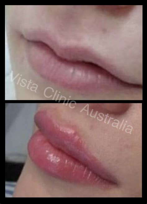 LIPS | BEFORE AND AFTER - Vista Clinic Melbourne