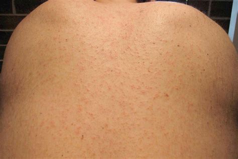 German Measles In Adults