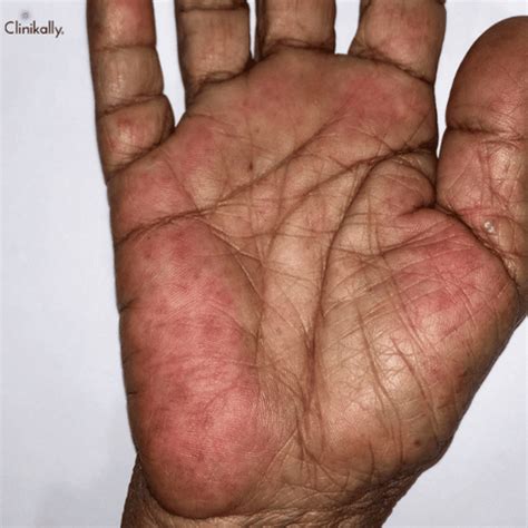 Palmar Erythema(Itchy, Red Palms): Causes & Treatment | Clinikally
