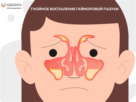 Симптомы и признаки гайморита у взрослых с температурой и без