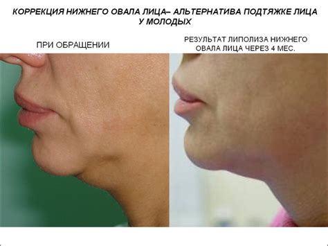 Лазерная липосакция - Киев, Украина