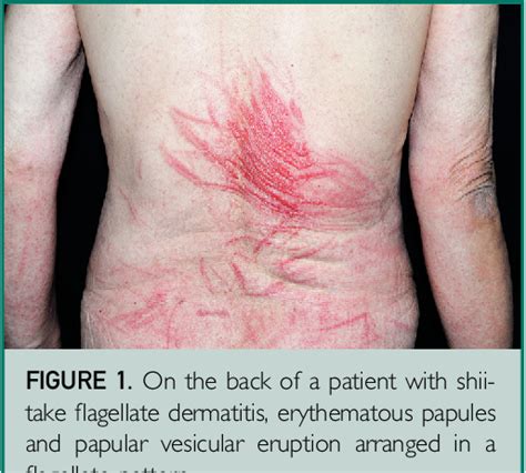 Figure 1 from Shiitake Flagellate Dermatitis. | Semantic Scholar