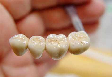 Этапы установки пластмассовых коронок – стоматология Президент