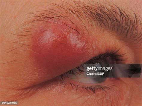 30 Sebaceous Cyst Stock Photos, High-Res Pictures, and Images - Getty Images