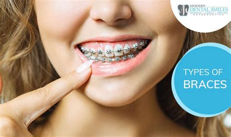 types  braces    types  braces ways