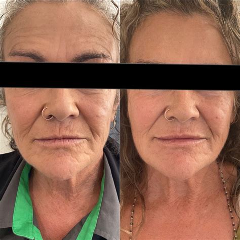 Before & After Photos - Rotorua Appearance Medicine - Freya Aesthetics