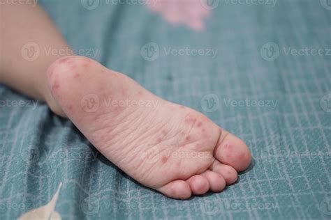 close up view of child's feet infected with hand feet and mouth disease